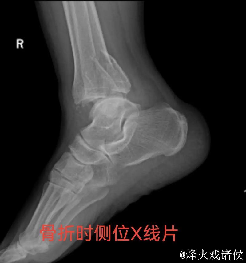 林孝天重伤!右踝三角韧带断裂 右侧腓骨骨折 林孝天重伤!右踝三角韧带断裂 右侧腓骨骨折